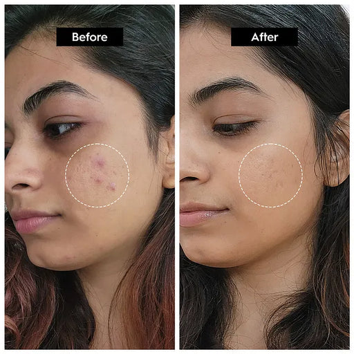 Ordinary Niacinamide 10% + Zinc 1%